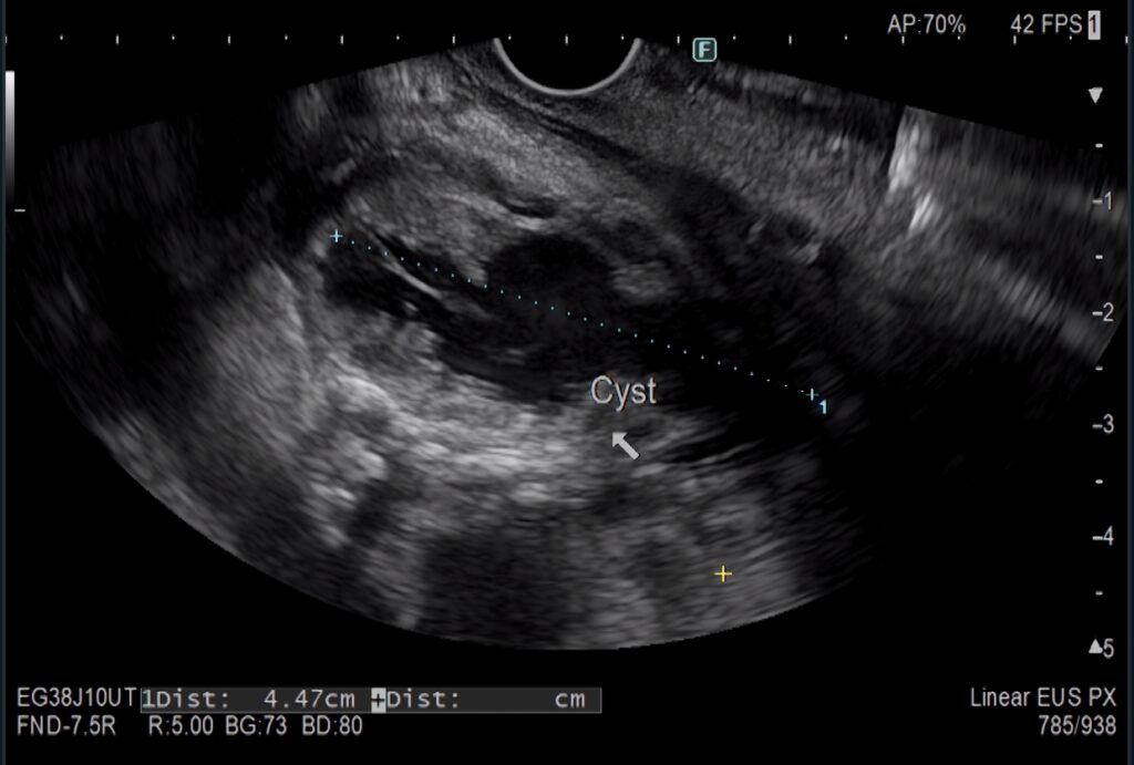 A black and white image of an Endoscopic Ultrasound. The image shows a suspiciously dark area, measured as being over 4cm across, which is out of keeping with the other tissues highlighted in the image.