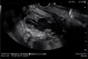 A black and white image of an Endoscopic Ultrasound. The image shows a suspiciously dark area, measured as being over 4cm across, which is out of keeping with the other tissues highlighted in the image.