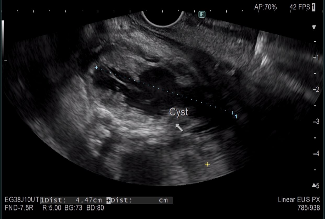 A black and white image of an Endoscopic Ultrasound. The image shows a suspiciously dark area, measured as being over 4cm across, which is out of keeping with the other tissues highlighted in the image.